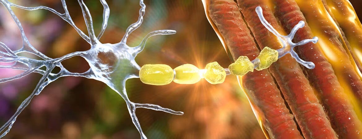 demyelination of neuron getty images